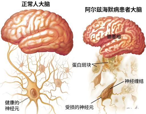 阿尔茨海默治疗仪:阿尔茨海默症和老人痴呆的区别是什么?