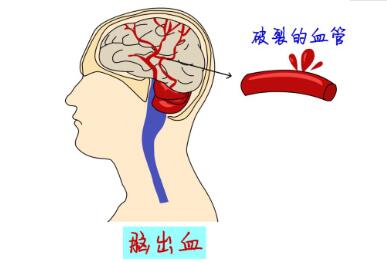 脑出血脑功能康复治疗仪|预防脑出血的关键是什么