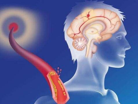 奧博脑功能康复治疗仪_脑血栓后遗症是啥症状