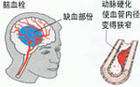 奧博脑功能康复治疗仪_如何预防脑血栓有效的方法 