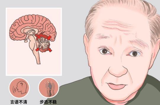 脑萎缩奥博脑功能康复治疗仪_怎样做预防脑萎缩出现?