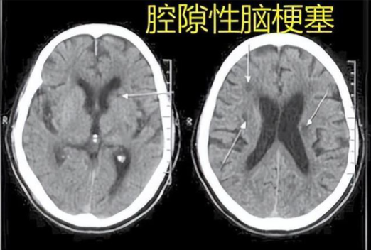 奥博脑功能康复治疗仪_腔隙性脑梗塞需要治疗吗