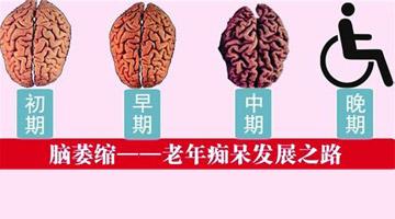 经颅磁电脑功能康复治疗仪_脑萎缩最好的恢复方法