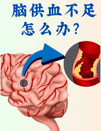 奥博脑功能康复治疗仪效果_为什么会脑供血不足呢 