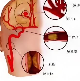 脑功能康复治疗仪辅助_脑出血后遗症说话不清楚能恢复吗