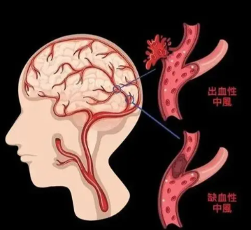 脑出血奥博康复仪器_脑出血的危险期是几天