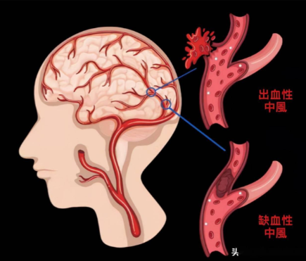 奥博甄选脑梗康复治疗仪_什么才叫轻微脑梗