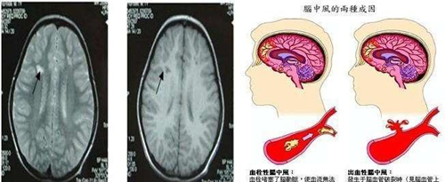 帮助脑血栓康复治疗的仪器_脑血栓人是清醒的吗