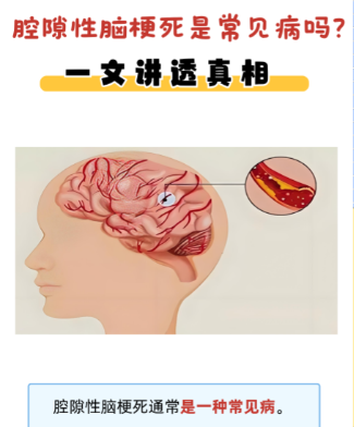治疗腔梗的物理仪器_腔梗的早期症状有哪些