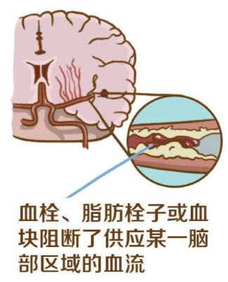 脑栓塞用物理治疗仪有用吗_脑栓塞如何快速康复