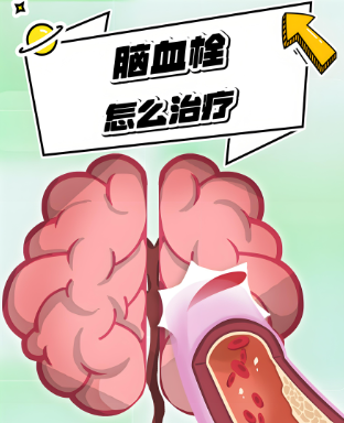 奥博脑血栓物理治疗仪器_脑血栓什么原因引起的