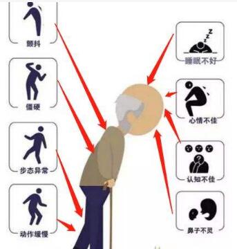 帕金森治疗仪器有效果吗_帕金森震颤特点有哪些
