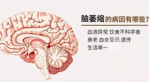 脑萎缩辅助治疗方法_脑萎缩是什么病