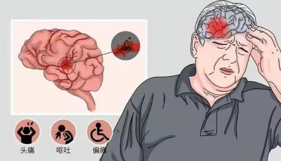 奧博治疗仪治疗优势_什么是脑栓塞症状