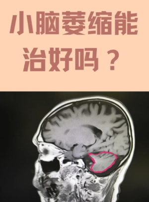 脑功能康复治疗仪效果|小脑萎缩最后是什么状态