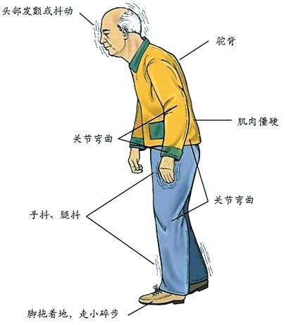 帕金森治疗仪的优势_帕金森综合症怎么查出来