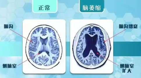 经颅电脑功能康复治疗仪_大脑萎缩的临床症状