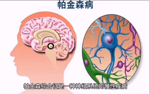 帕金森治疗仪的效果|帕金森综合征是不治之症吗
