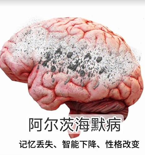 家用阿尔茨海默治疗仪——阿尔茨海默症什么年龄 