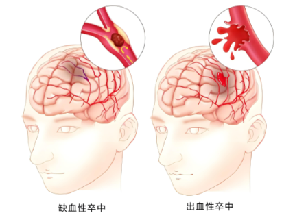 孙作东奥博脑功能治疗仪_TIA一般多久发病一次