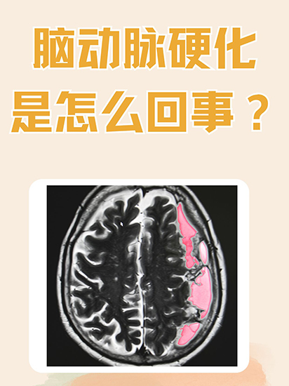 AOBO奥博脑康复治疗仪_脑动脉硬化怎么缓解症状