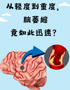 奥博治疗仪官网_脑血管萎缩和脑血管病性脑萎缩的区别