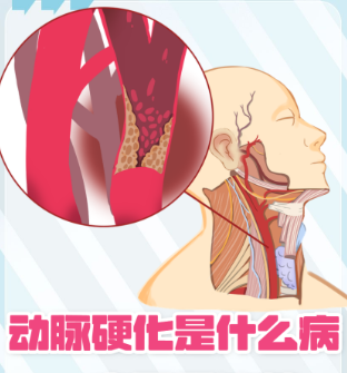 南京奥博医疗器械_脑动脉硬化怎么来的