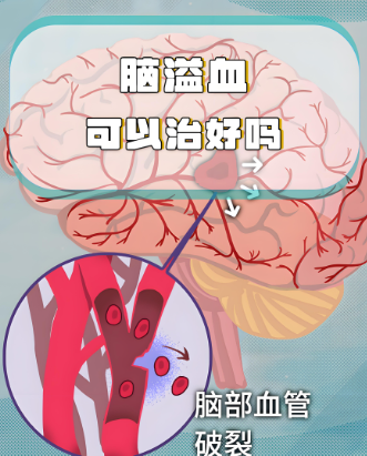 哈尔滨奥博脑溢血康复治疗仪_脑溢血跟高血压有什么关系