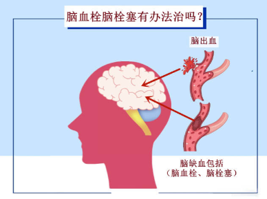 脑血栓治疗方法孙作东治疗仪_脑血栓可以治愈吗 