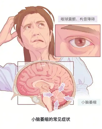 小脑萎缩的仪器奥博治疗仪_小脑萎缩会不会导致健忘