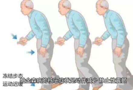 孙作东奥博帕金森家用治疗仪器_帕金森的并发症