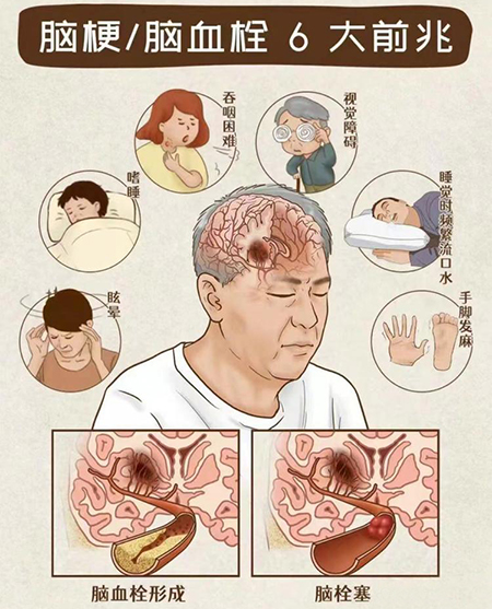 奥博甄选脑栓塞治疗指南_脑栓塞有什么后遗症吗