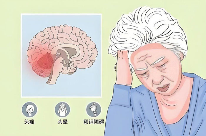 奥博脑萎缩家庭治疗仪效果_大脑萎缩和小脑萎缩一样 
