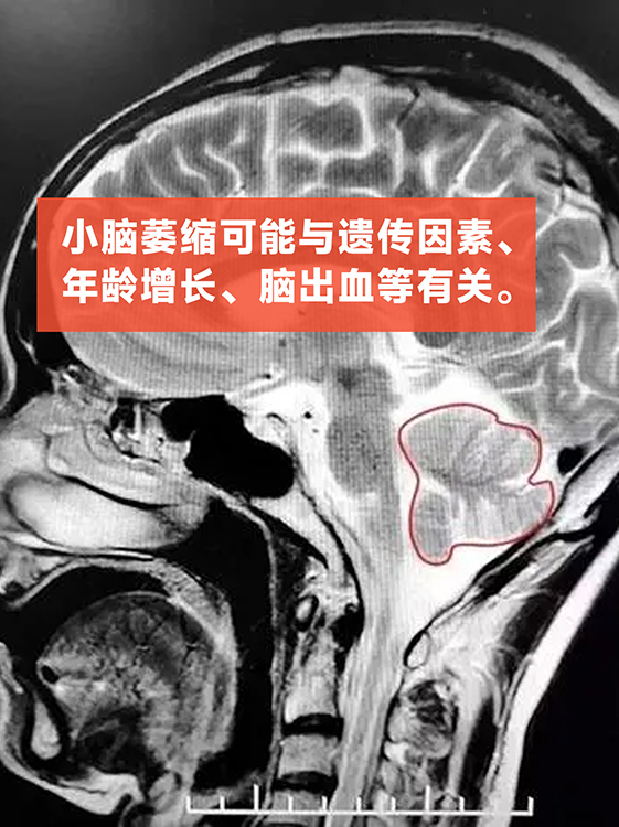 小脑萎缩治疗仪器奥博甄选_小脑萎缩会不会遗传