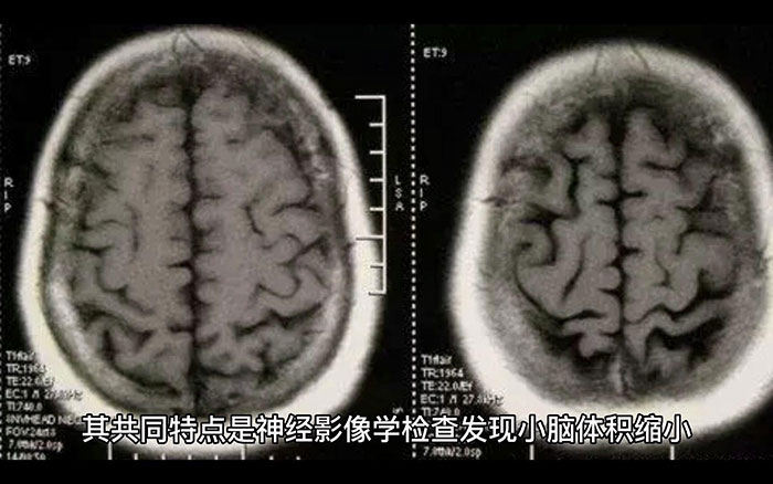 小脑萎缩辅助工具_什么人容易得小脑萎缩