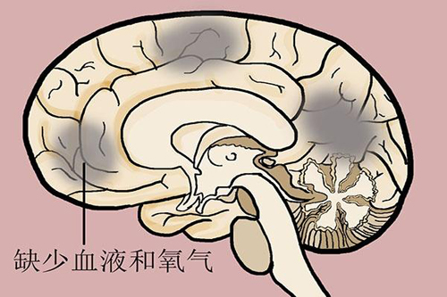 奥博甄选居家治疗仪_脑梗病人晚期什么症状