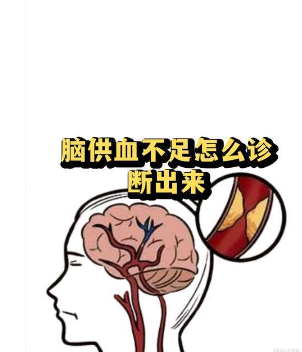 奥博甄选脑供血不足物理方式_脑供血不足原理解析