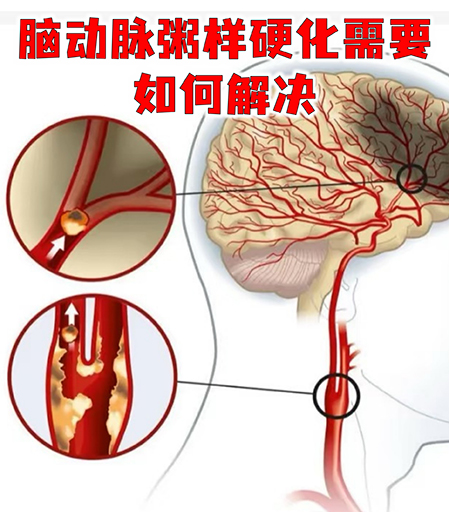 奥博仪器无创经颅电刺激技术_脑动脉硬化分几个阶段?