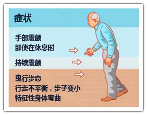 奥博经颅磁电刺激仪_帕金森晚期最严重的症状?