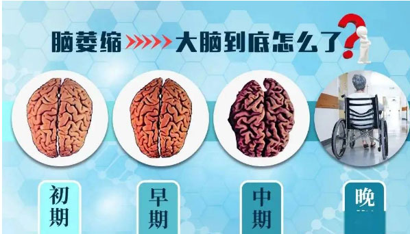 奥博甄选经颅电刺激原理_脑萎缩走路不稳还能恢复吗?