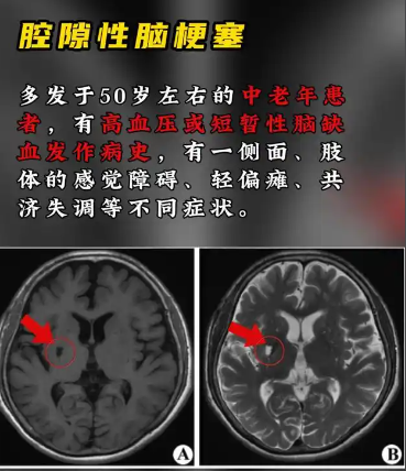 奥博甄选家用治疗仪_腔梗可以恢复吗?