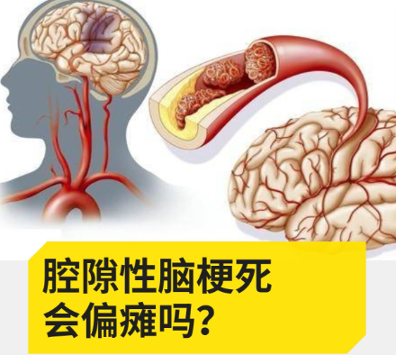 奥博家用经颅电刺激仪_腔隙性脑梗塞好治吗?