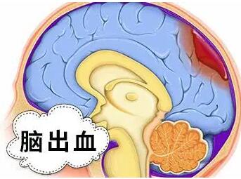 奥博甄选家庭护理仪器_脑溢血的前兆是什么现象?
