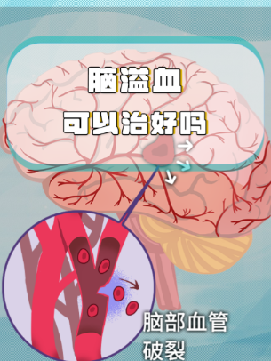 奥博甄选脑溢血家用仪器_脑溢血怎么查出来?