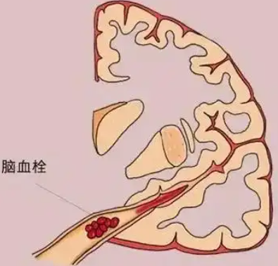 南京奥博医疗器械_读懂脑血栓早期危险信号
