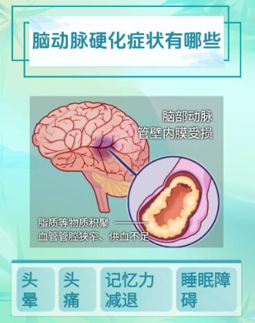奥博经颅直流电刺激治疗仪_脑动脉硬化发病率高吗?